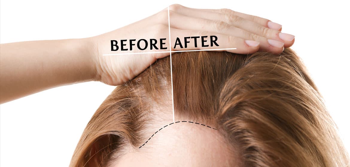 Hair Transplant- treatment & Cost