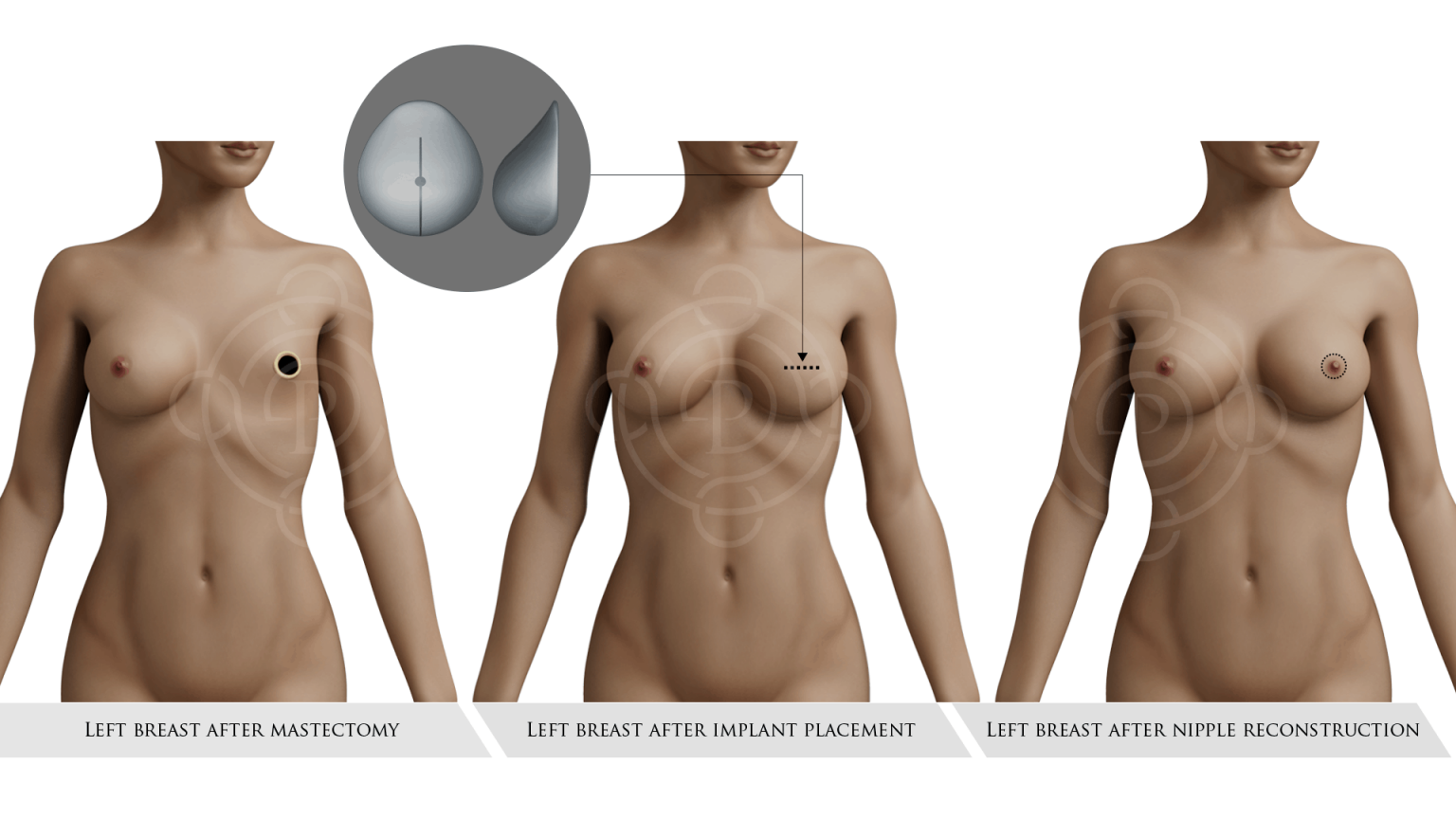 Breast- Nipple Reconstruction