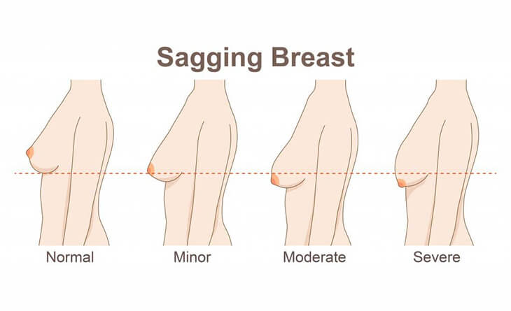 Breast Lift- Procedure & Cost