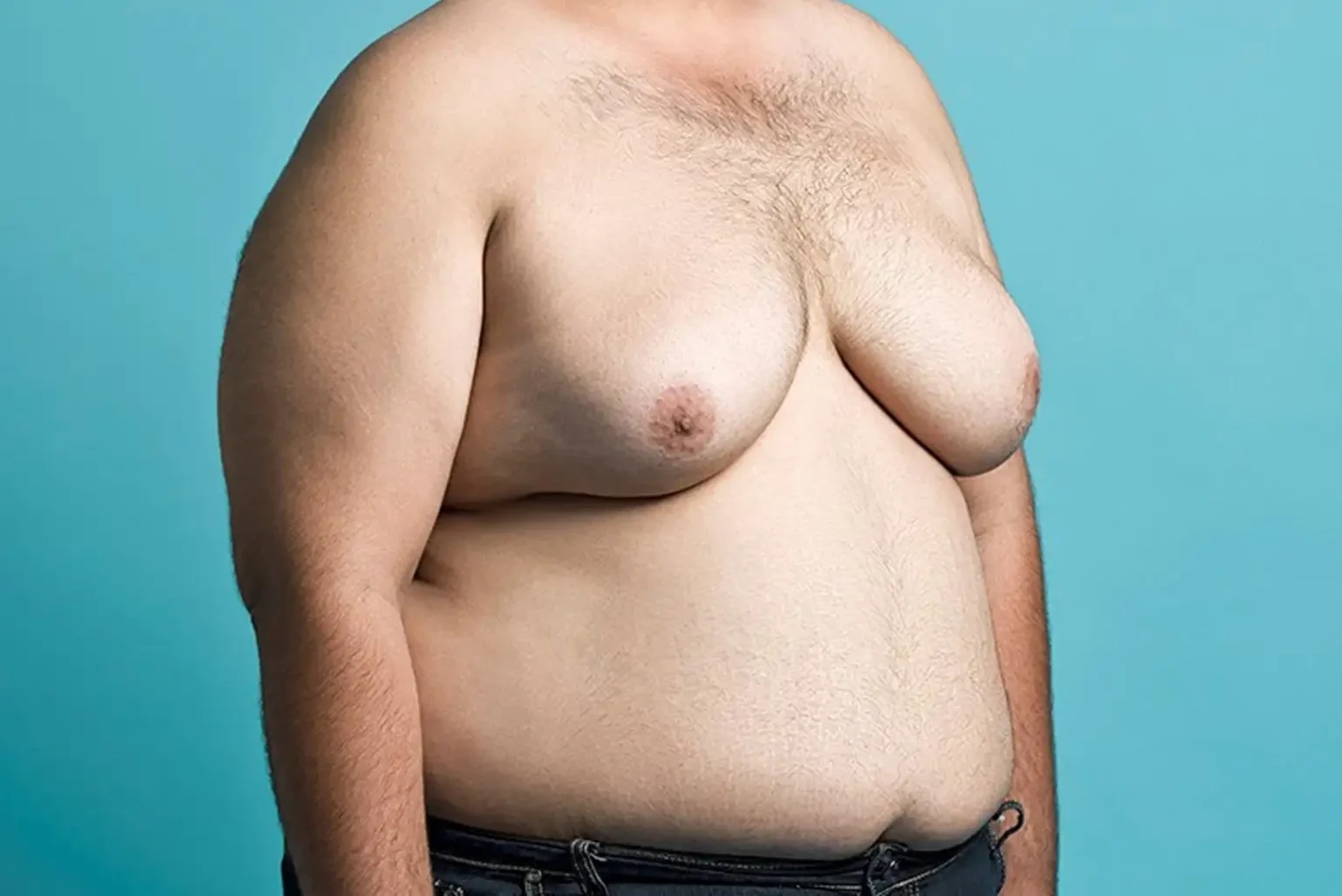 Breast Reduction in Male Person