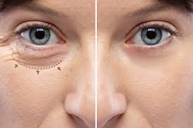 Eyelid Surgery-Procedure & Cost