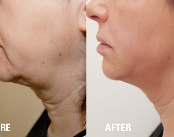 Face & Neck Lift