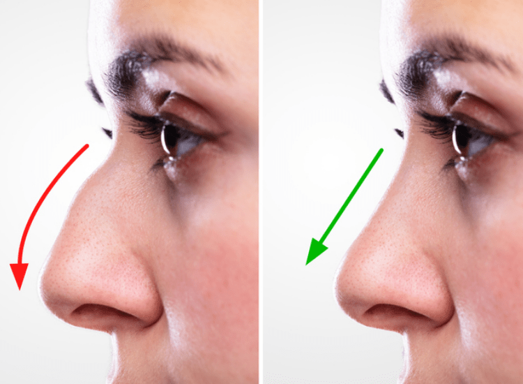 Rhinoplasty-Nose Surgery